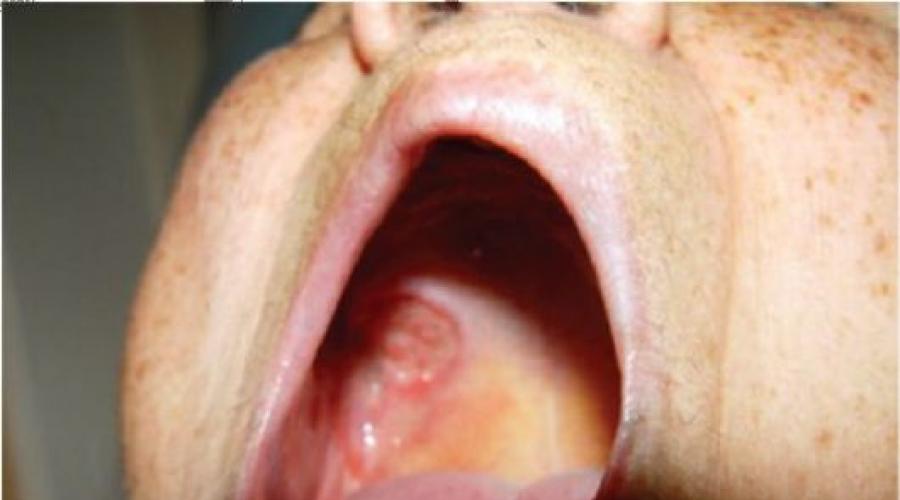 Диагностика и лечение злокачественных опухолей полости рта. Симптомы рака полости рта: как вовремя их распознать? Регионарные лимфатические узлы