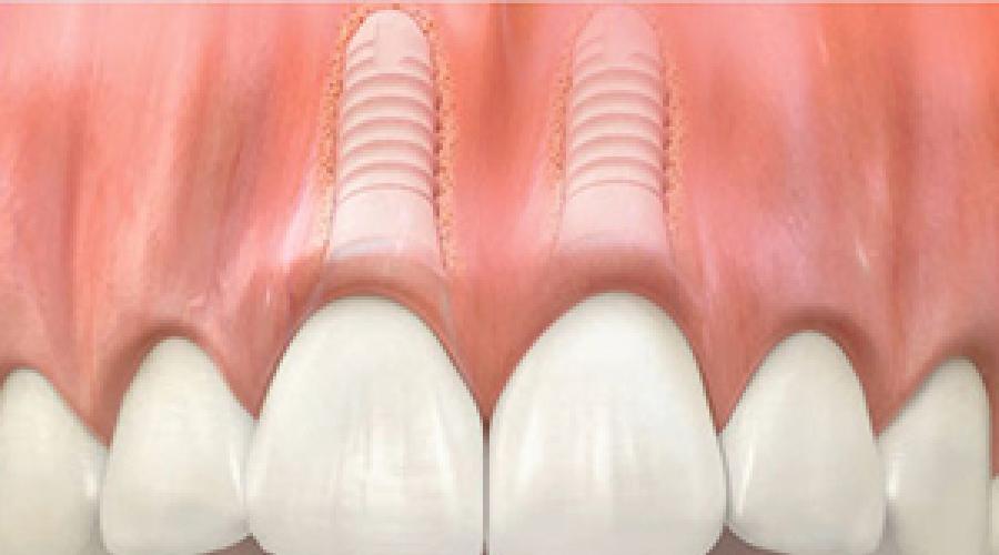 Коронка двойная на два зуба. Двойные коронки без фрикции Виды и характерные особенности разных зубных имплантатов