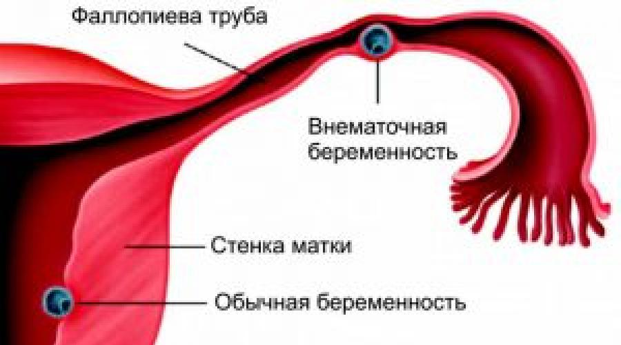 Выделяется ли хгч при внематочной беременности. ХГЧ при внематочной беременности: показатели нормы, динамика роста. Методы лечения аномальной беременности