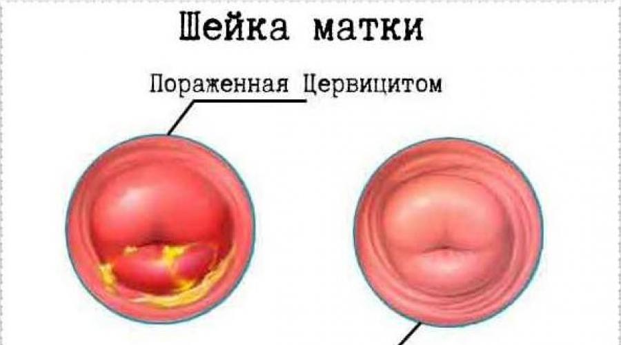 Шейка матки конической формы. Гонококковый цервицит. Воспаление шейки матки цервицит.