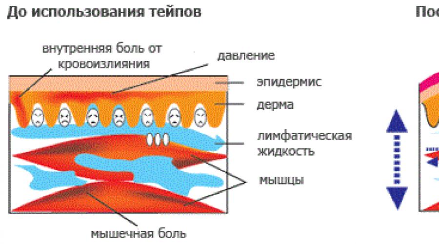 Схемы наклейки тейпов