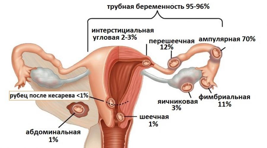 Внематочная беременность диагноз. Признаки и методы лечения внематочной беременности на ранних сроках. Чем опасна внематочная беременность