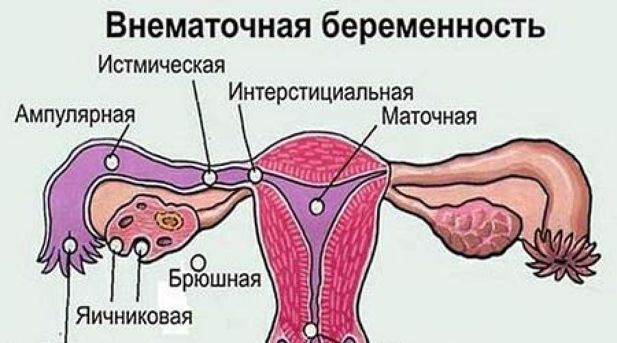 Причины приводящие к развитию внематочной беременности. Почему происходит внематочная беременность. Прогнозы при внематочной беременности